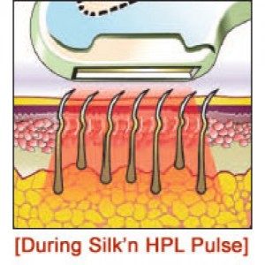 Silk'n Pro zestaw do depilacji światłem IPL    